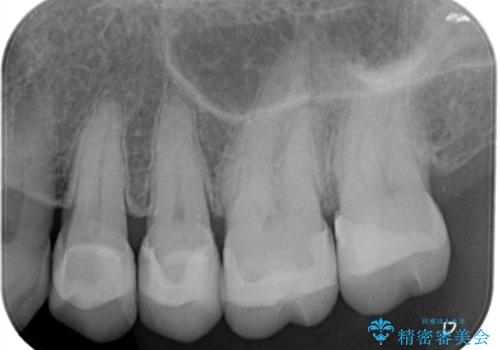【メタルフリー】セラミックインレーによる治療の治療後