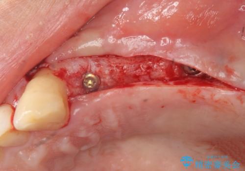 インプラント治療で達成する奥歯のしっかりとした咬合の治療前