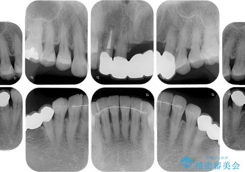 気になる所を一気に治療 総合歯科治療の治療後