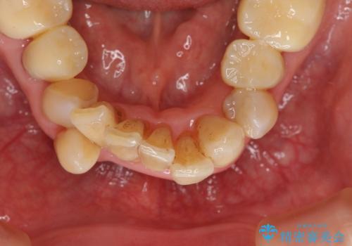 矯正治療とセラミック治療で口腔内環境を劇的に改善の治療中
