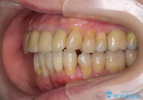 矯正治療とセラミック治療で口腔内環境を劇的に改善の治療後