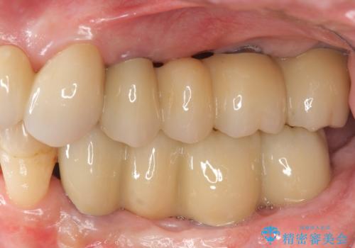 多発した虫歯による咬合崩壊    インプラントを用いた全顎治療の治療後