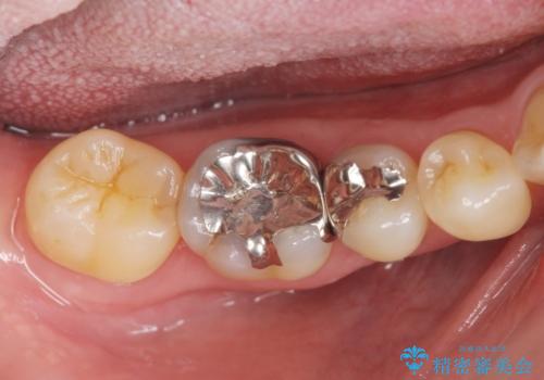 インレーとクラウン 銀歯をセラミックにやりかえの症例 治療前