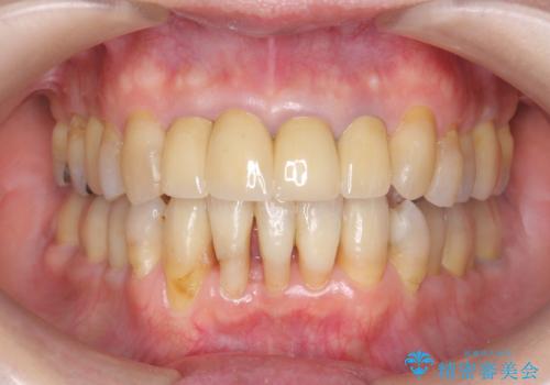 矯正治療とセラミック治療で口腔内環境を劇的に改善の症例 治療後