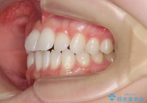 [ インビザライン矯正 ]  マウスピース矯正で治す、前歯のガタつきの治療前