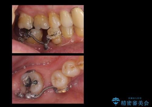 60代男性 奥歯のブリッジ 倒れこんでいる奥歯を部分矯正の治療中