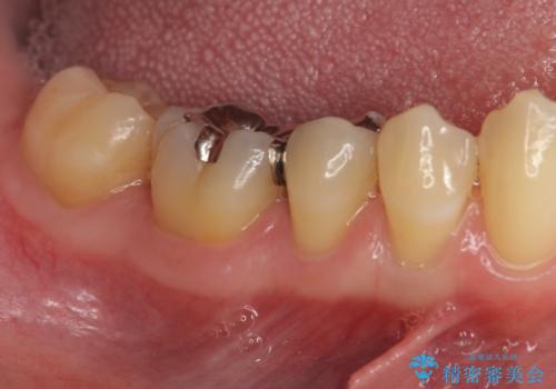 インレーとクラウン 銀歯をセラミックにやりかえの治療前