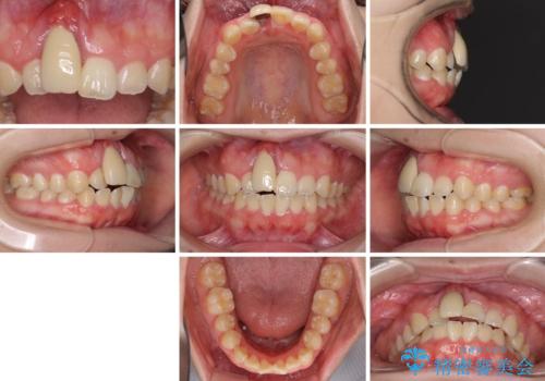 怪我をして不格好な前歯 矯正治療とインプラント補綴治療の治療前