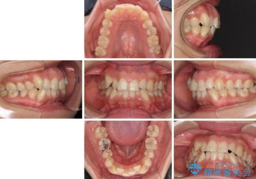 前歯のデコボコを短期間で解消　ワイヤー装置による抜歯矯正の治療前