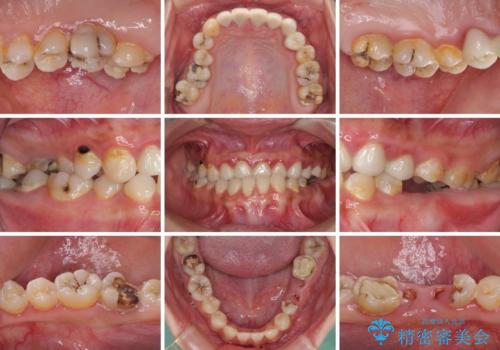 むし歯だらけの奥歯　セラミッククラウンによるむし歯治療の治療前