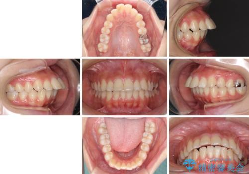 突出した口元が気になる ハーフリンガル装置による抜歯矯正の治療前