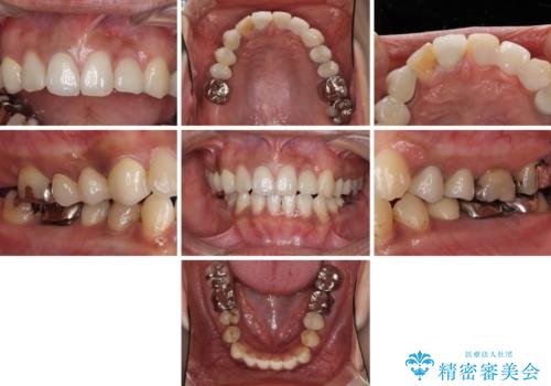 以前治療した歯が続々とむし歯に 全顎むし歯治療の治療前