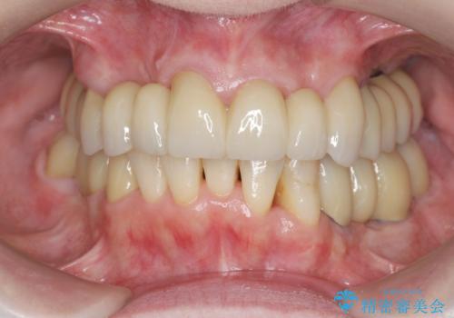 多発した虫歯による咬合崩壊    インプラントを用いた全顎治療の治療後