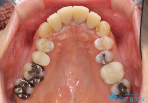 矯正治療とセラミック治療で口腔内環境を劇的に改善の治療中