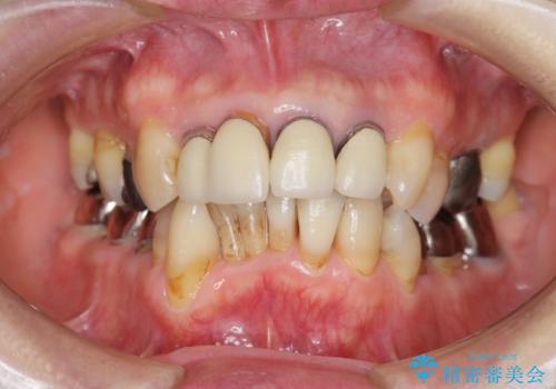 矯正治療とセラミック治療で口腔内環境を劇的に改善の症例 治療前