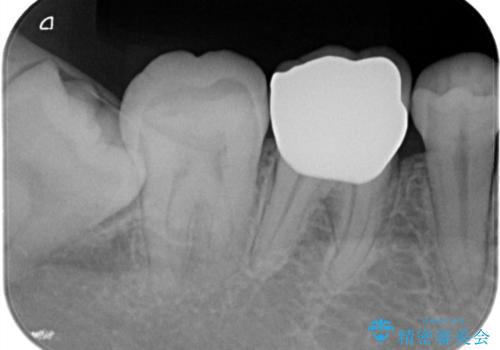 【オールセラミッククラウン】存在感のある銀歯を外したいの治療後