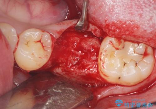 インプラントによる咬合機能回復の治療中