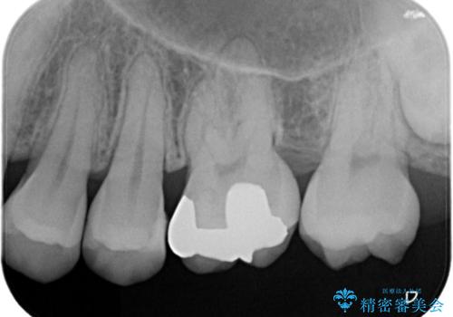 【メタルフリー】矯正後に歯を白くしたい。の治療前