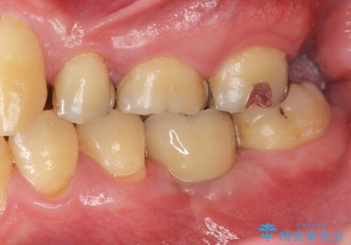 インプラントによる咬合機能回復の治療後