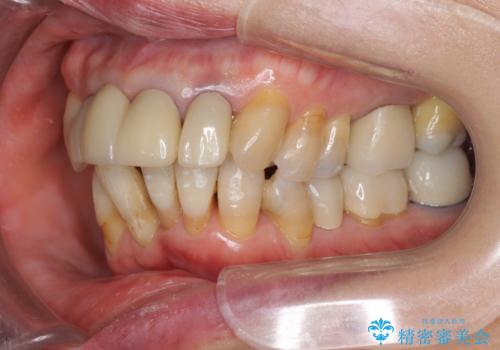 矯正治療とセラミック治療で口腔内環境を劇的に改善の治療中