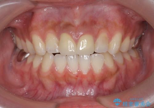 [ セラミック治療  ]   前歯を自然にしたい、セラミッククラウンのやりかえの治療後