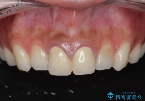 [ セラミック治療  ]   前歯を自然にしたい、セラミッククラウンのやりかえの症例 治療前