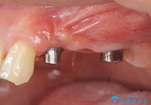 インプラント治療で達成する奥歯のしっかりとした咬合の治療中