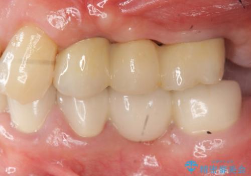 インプラント治療で達成する奥歯のしっかりとした咬合の治療後