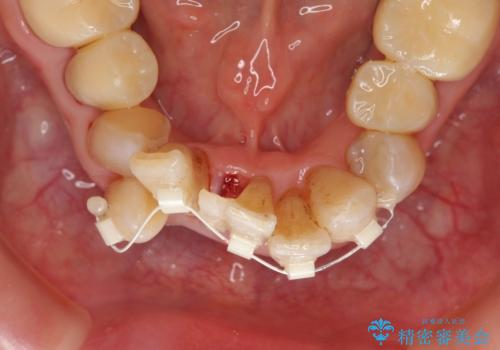 矯正治療とセラミック治療で口腔内環境を劇的に改善の治療中