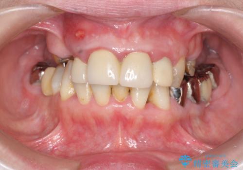 多発した虫歯による咬合崩壊    インプラントを用いた全顎治療の症例 治療前