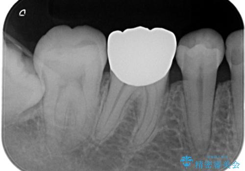 【オールセラミッククラウン】存在感のある銀歯を外したいの治療前