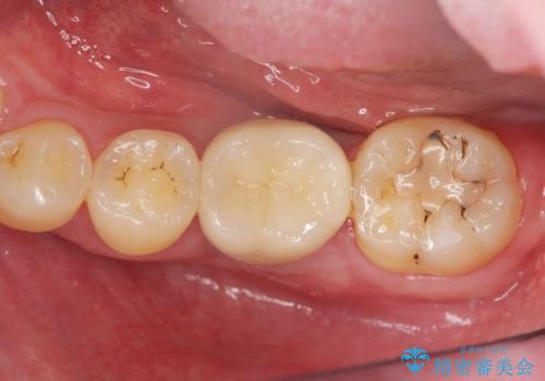 インプラントによる咬合機能回復の治療後