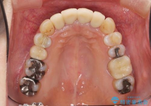 矯正治療とセラミック治療で口腔内環境を劇的に改善の治療後