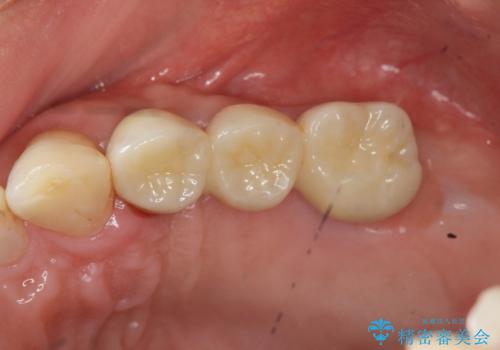 インプラント治療で達成する奥歯のしっかりとした咬合の治療後