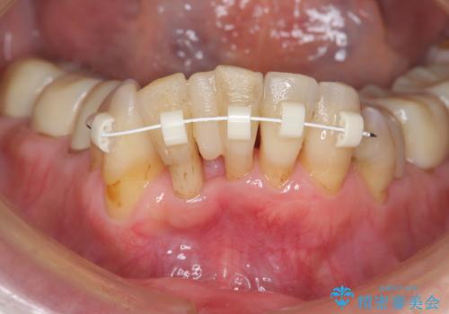 矯正治療とセラミック治療で口腔内環境を劇的に改善の治療前