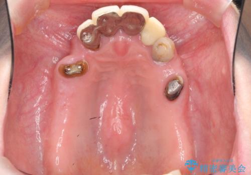 多発した虫歯による咬合崩壊    インプラントを用いた全顎治療の治療前