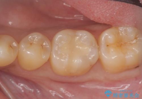 「セラミックインレー」目立つ下顎の銀歯を白くしたいの症例 治療後