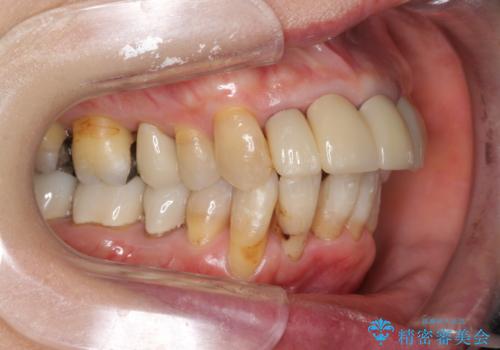 矯正治療とセラミック治療で口腔内環境を劇的に改善の治療中