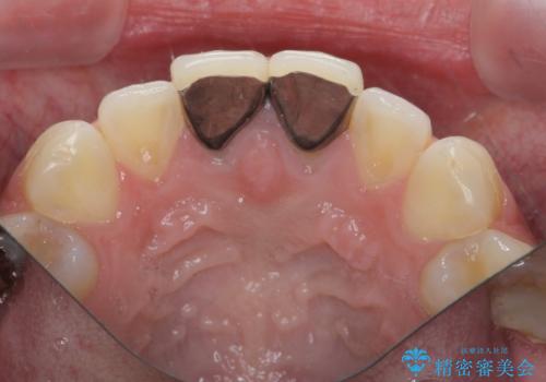 [ セラミック治療  ]   前歯を自然にしたい、セラミッククラウンのやりかえの治療前