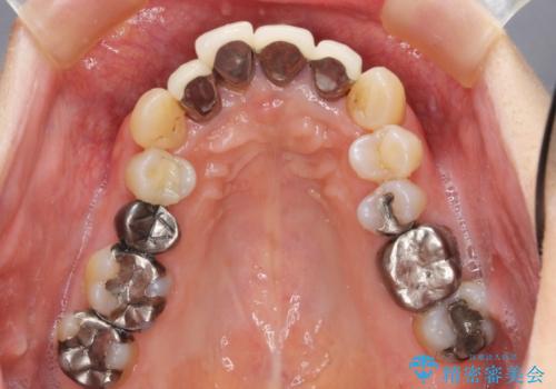 矯正治療とセラミック治療で口腔内環境を劇的に改善の治療前