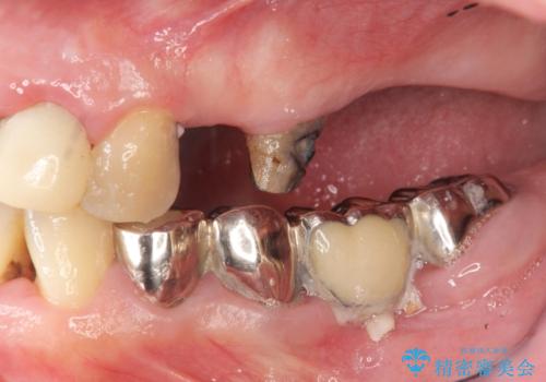 多発した虫歯による咬合崩壊    インプラントを用いた全顎治療の治療前