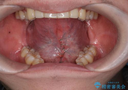 舌小帯の形成で達成する滑舌の改善の治療中