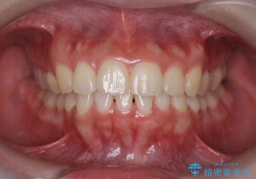 マウスピース　狭窄歯列の改善の症例 治療後