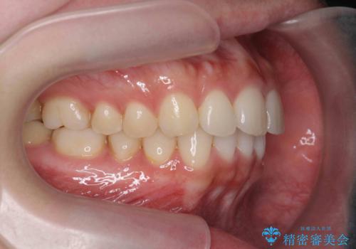 マウスピース 狭窄歯列の改善の治療後