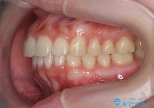 マウスピース 狭窄歯列の改善の治療後