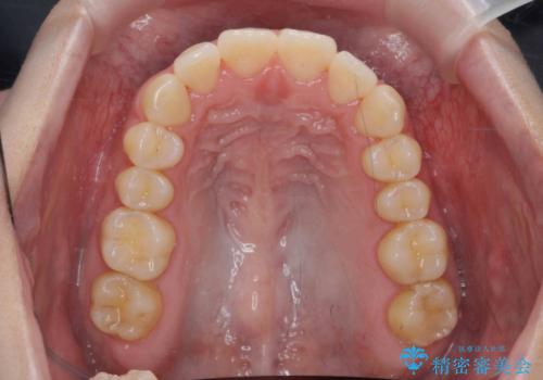 マウスピース 狭窄歯列の改善の治療後
