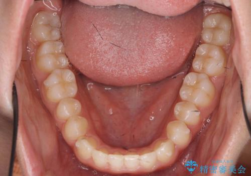 前歯のガタつきを改善　マウスピース矯正とワイヤー部分矯正の治療後