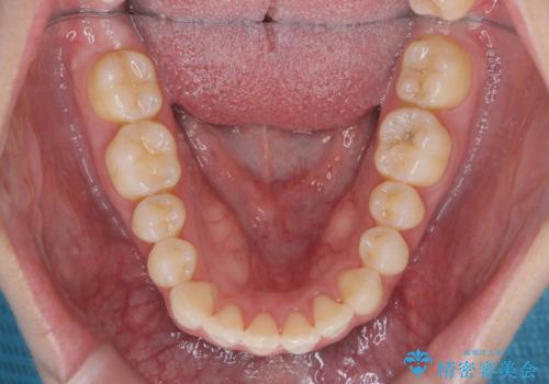 マウスピース 狭窄歯列の改善の治療後