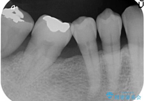60代男性 奥歯のブリッジ 倒れこんでいる奥歯を部分矯正の治療前