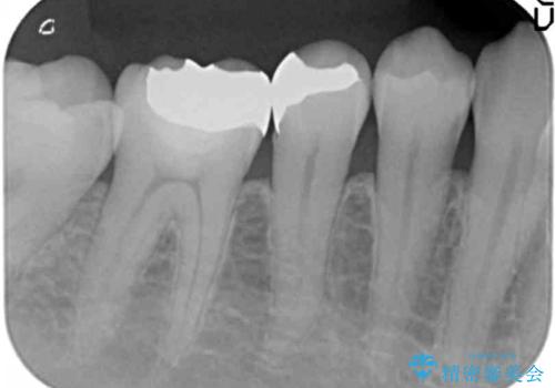 インレーとクラウン 銀歯をセラミックにやりかえの治療前